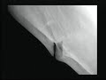 Granular Eruption