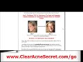 Best Acne Treatment - How To Get Rid of Acne With Acne Free in 3 Days?