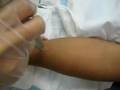 Laser Tattoo Removal