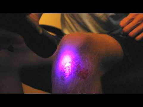 Using 405nm light to kill bacteria