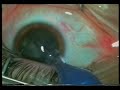 oftalmología cirugia de facoemulsificacion oftalmología cirugia de facoemulsificacion