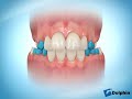Quad Helix Expander