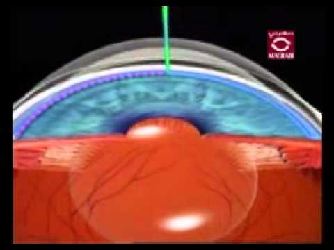 how to cure glaucoma