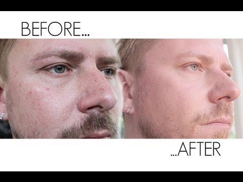 HOW I HEALED MY SKIN - ACNE BREAKOUTS!!!!