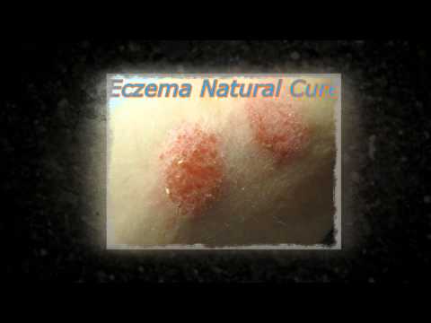 how to treat eczema at home