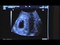 Baby Hosch Week 6 Day 2 04-10-2008 Baby Hosch Week 6 Day 2 04-10-2008