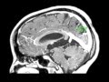 Endoscopic treatment of a third ventricle choroid plexus cyst