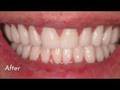 Veneers - Cosmetic Dentistry a favorite of Dr. Patel