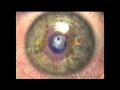 Gulani Keratoconus Surgeries: Think Beyond the CONE