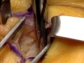 Podcast: See a live surgery for carpal tunnel syndrome