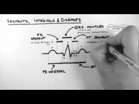 how to calculate qt interval