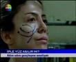 Op. Dr. Tunç TİRYAKİ - Yüz Asma Operasyonu