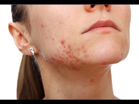 how to get rid of an acne scars