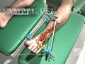 Below the Knee Amputation Surgery(Amputated Leg)