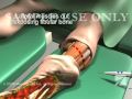 Below the Knee Amputation Surgery(Amputated Leg)