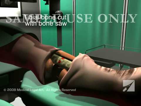 how to properly amputate a limb