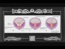 Congenital Diaphragmatic Hernia Part 1