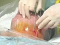 Saving the Shoulder: Less Invasive Shoulder Surgery Saving the Shoulder: Less Invasive Shoulder Surgery