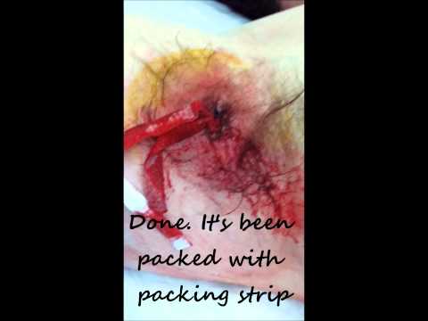 how to drain appendix abscess
