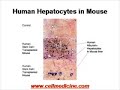 Cord Blood and Bone Marrow Stem Cells for Liver Failure Cord Blood and Bone Marrow Stem Cells for Liver Failure
