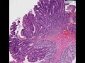 Histopathology Colon --Tubular adenoma (adenomatous polyp) Histopathology Colon --Tubular adenoma (adenomatous polyp)