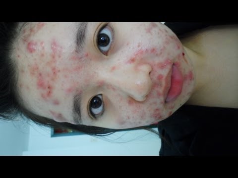 My Acne Story - Birth Control Pills (For Accutane)
