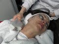 Skin Tightening, Wrinkle reduction, skin care, skin rejuvenation, neck wrinkles