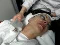 videos de Skin Tightening, Wrinkle reduction, skin care, skin rejuvenation, neck wrinkles