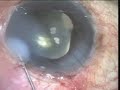 Phaco Trabeculectomy, two ports