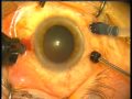 20 gauge sutureless vitrectomy Dr Salmeri