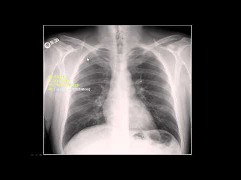 how to assess chest x ray