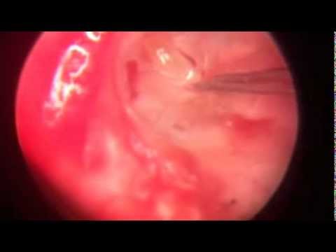 how to drain fluid behind eardrum