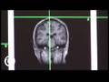 Deactivate ur Brain's Selected Parts, Use Transcranial Magnetic Stimulation !!