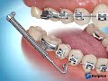 Overbite Correction in Braces