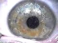 The Video that LASIK Doctors Don\