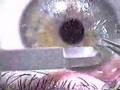 The Video that LASIK Doctors Don't Want You To See