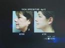 In the News: Dr. Mahmud's Non-Surgical Facial LipoSculpture Expertise