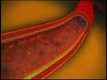 Atherosclerosis