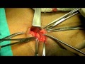 DIRECT INGUINAL HERNIA-BY DR. SACHIN GUPTA M.S.(AYU)-09760060202