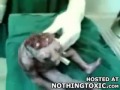 Bebe deforme (anencefalia)