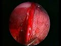 Extraperitoneal Hernia Repair Extraperitoneal Hernia Repair