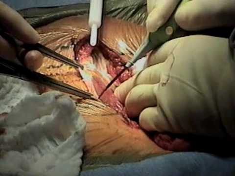 penectomy