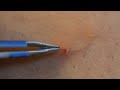 Disgusting ingrown hair