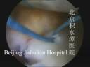 arthroscopic bankart repair