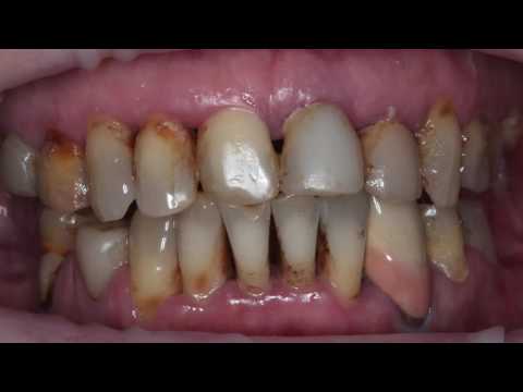 Практикум по пластике мягких тканей десны в области зубов и имплантатов. Часть 21