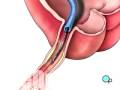 videos de Malpractice Medical Stent Implantation Coronary Angioplasty Surgery 3