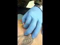 Zaks cyst