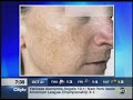 Photorejuvenation