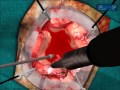 Microneurosurgery Training - NeuroTouch Simulator - Part 1 Microneurosurgery Training - NeuroTouch Simulator - Part 1