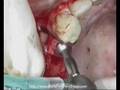 Live surgery part2